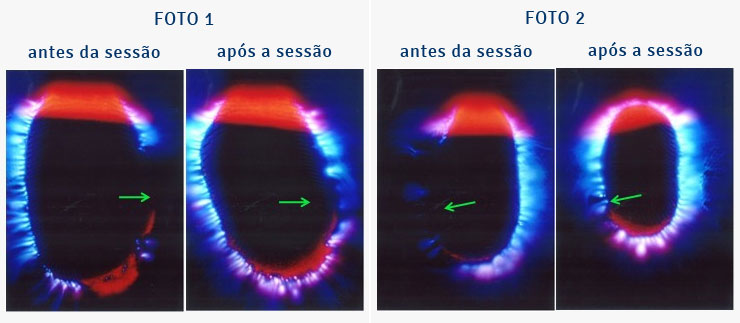 Foto Kirlian - esquizofrenia e depressão