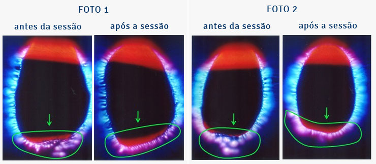 Foto Kirlian - estresse e hipotireoidismo